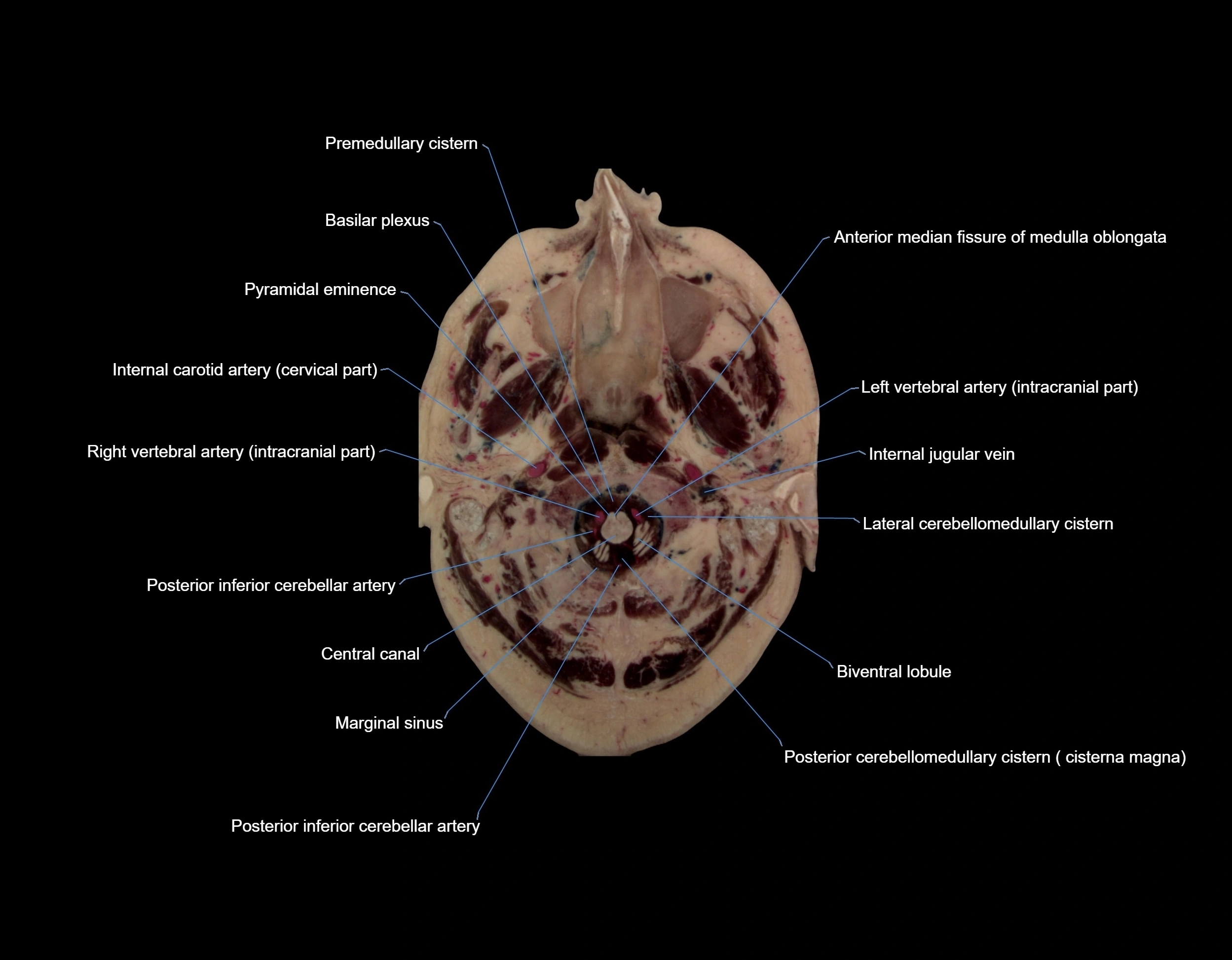 MRI Brain axial cross sectional radiology anatomy 3T image  -img-00001.webp